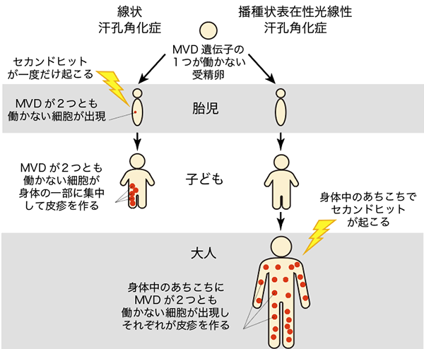 図3．2種類の汗孔角化症が起こる仕組み