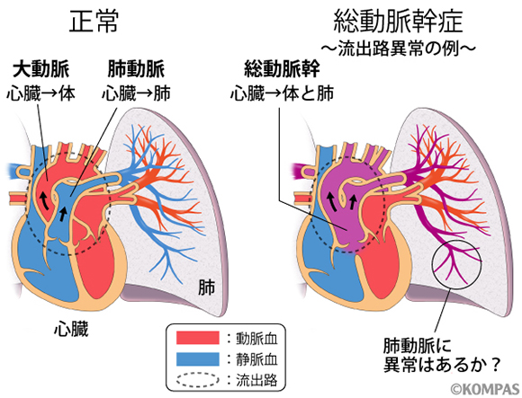  図1. 先天性心疾患の約30％を占める流出路異常とそれに伴う肺動脈の異常を考える