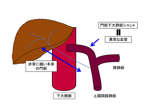 図1b．門脈下大静脈シャントにおける血行動態