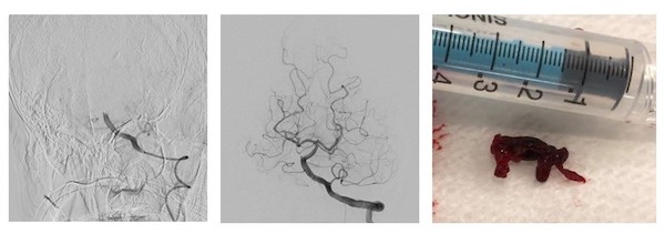 図2　（左）：血管閉塞（脳底動脈）（中央）：血管内治療、再開通（右）：回収された血栓