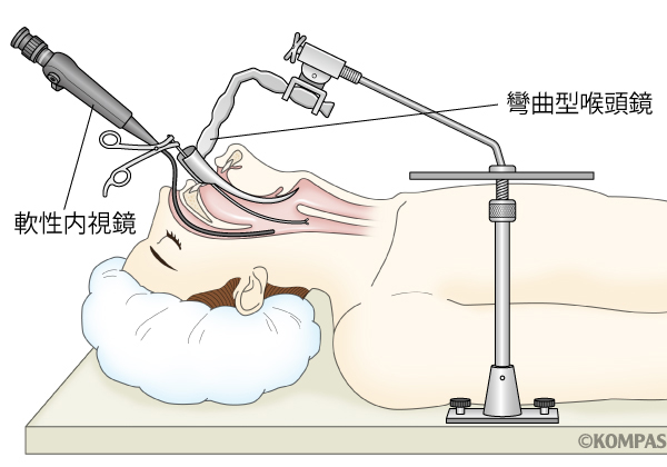 図３．彎曲型喉頭鏡＋軟性内視鏡によるELPS（内視鏡的咽喉頭手術）