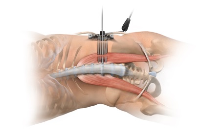 図8. イメージ：側方経路椎体間固定術