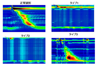 図１．高解像度内圧測定によるアカラシアの分類