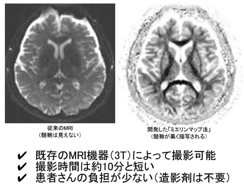 図3.MRI(3テスラ装置)によりミエリン可視化に成功
