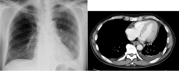 図２．左胸膜炎