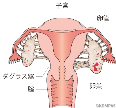 子宮内膜症（図１）