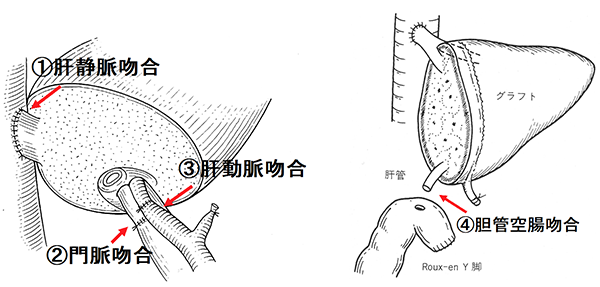 図５．肝移植の手術