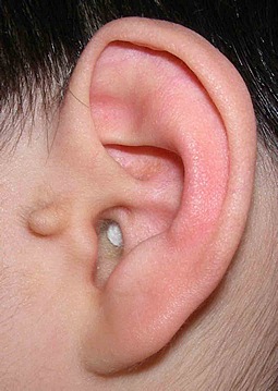 図２．副耳