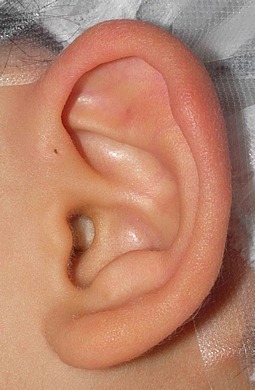 図３．耳瘻孔