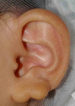 図４．耳垂裂