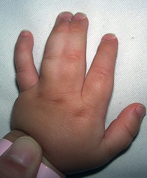 図１.合指症の例