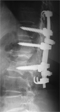 図1 後方短縮術による脊柱の矯正と固定（脊椎の後方部分を切除し圧縮力を加えて後弯を矯正する）