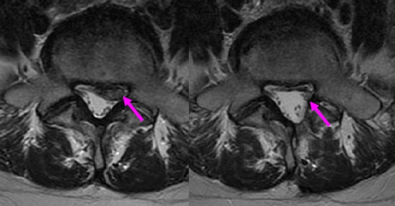 図２．左：後方髄核摘出術術前　　右：手術後