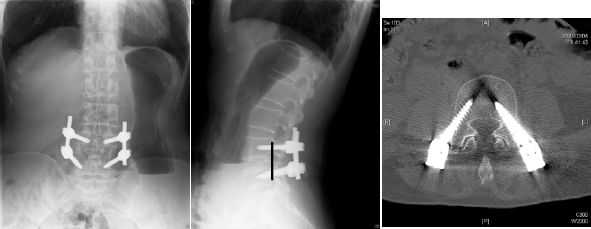 図３．後方進入椎体間固定術PLIF(TLIF)後（ずれている背骨が矯正されている：線）