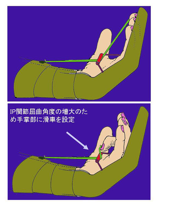 図４．腱縫合後の早期運動療法（Kleinert法）