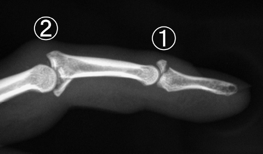 図１．骨性槌指（1）とPIP関節脱臼骨折（2）