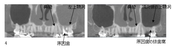図２．（左：左側上顎洞炎【原因歯は左側第一大臼歯】右：原因歯抜歯後）