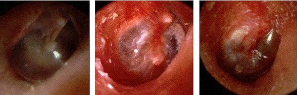 図２．左：正常の鼓膜、中央：初期の急性中耳炎、右：進行して膿が溜まった中耳炎