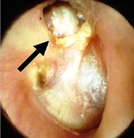 図５．真珠腫性中耳炎の鼓膜所見（矢印：鼓膜の陥凹）