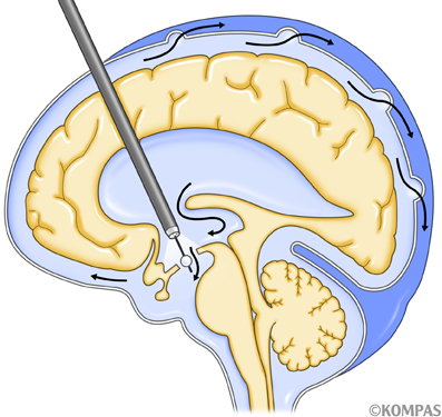 図３．神経内視鏡下第三脳室底開窓術