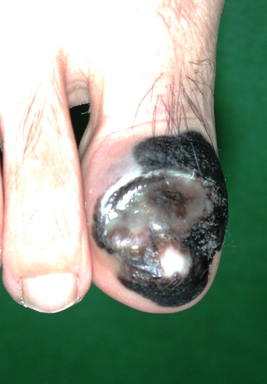 図１．足の指に生じた悪性黒色腫