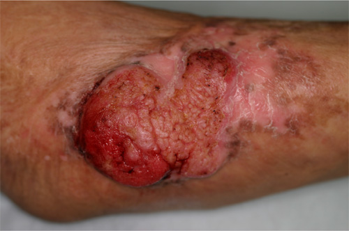 図１．火傷の傷痕（瘢痕）上に生じた有棘細胞がん