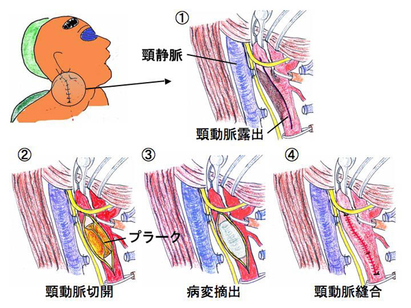 動脈 圧迫 頸 頸動脈狭窄症：原因、兆候、頻度、結果