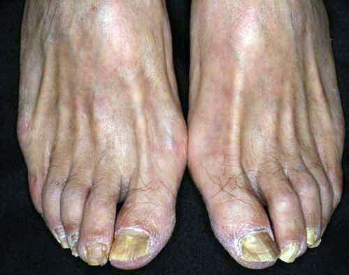 図１．爪白癬を合併した足白癬