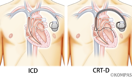 ICD/CRT-Dによる治療