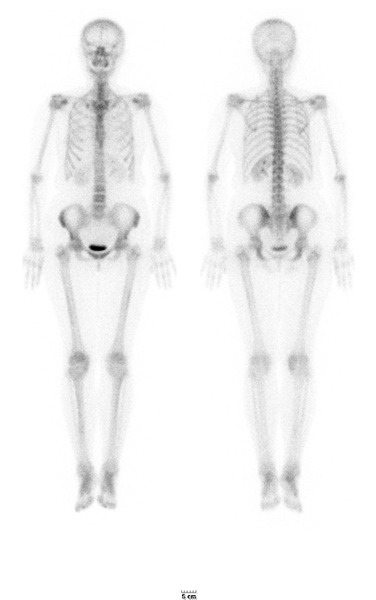 図１.骨シンチ 正常症例