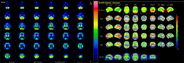 図１．脳血流画像（認知症）　典型的なアルツハイマー病の画像。後頭葉を除く大脳皮質に広範な血流低下が見られます。
