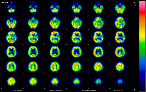 図２．脳血流画像（脳血管障害）　左内頚動脈狭窄の症例。左側の大脳皮質に広範な血流低下が見られます。