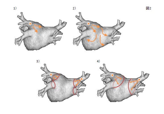 図２． 心房細動の発生の仕方とカテーテルアブレーション
