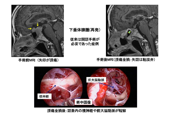 図４．下垂体腺腫の再発患者さんの例