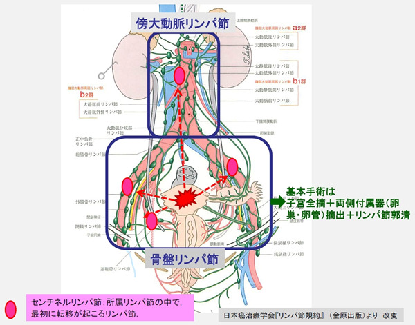 図1．子宮体がんの基本術式と骨盤リンパ節と傍大動脈リンパ節