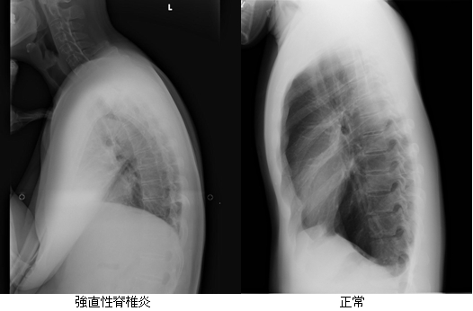 図２．強直性脊椎炎と正常人のX線写真