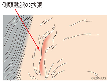 図１．側頭動脈の拡張