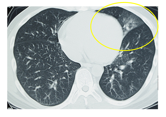 図３．胸部CTで肺の陰影を確認できる。