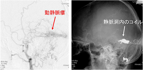 図4　経静脈的塞栓術で静脈洞内にコイルを留置した例