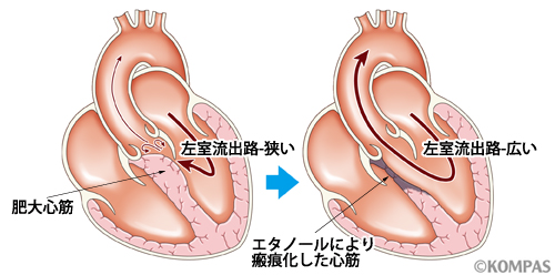 図2B　経皮的中隔心筋焼灼術前後の肥大心筋の退縮と左室流出路閉塞解除の様子（イメージ）