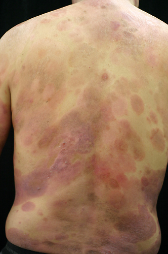 図１．背部に発疹が広がる菌状息肉症
