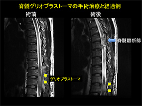 図1．脊髄離断術