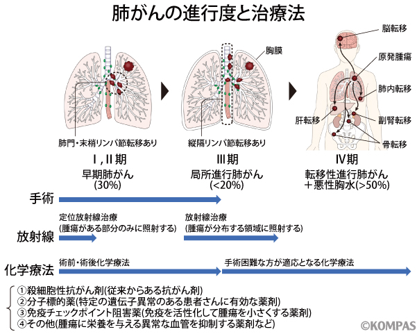 図１．肺がんの進行度と治療法
