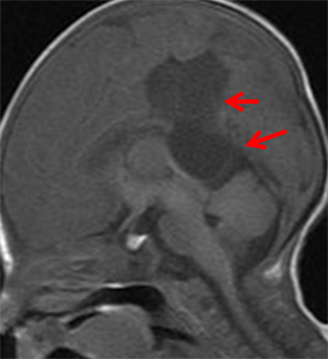 図2　新生児でMRI上大脳半球間裂にくも膜のう胞を認めます。その後も症状、発達等特に異常ありません。