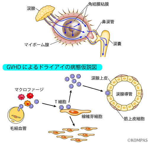 慢性GVHDによるドライアイの免疫応答と線維化の仮説図