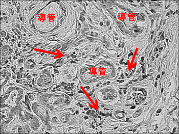 図1　GVHD涙腺におけるP16陽性細胞の浸潤
