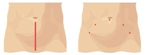 図1　開腹手術における切開部（左）およびダヴィンチ手術における切開部（右）