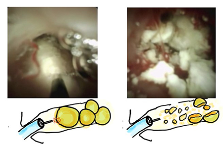 図2．膵管鏡を用いた膵石破砕処置　（患者さんより許可を頂いて掲載しております）