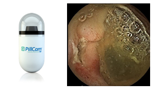 図1小腸カプセル内視鏡　図2小腸潰瘍をカプセル内視鏡で撮影した画像