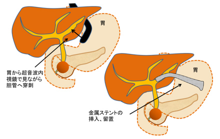 図３．超音波内視鏡による胆管および膵管ドレナージ術